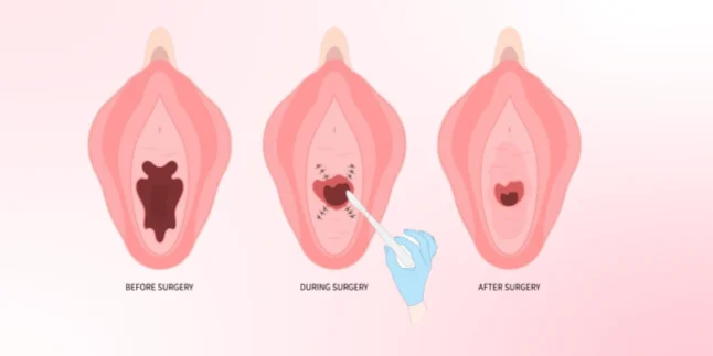 Vaginal Rejuvenation by Dr. Amulya Gumpalli in Madhapur, Hyderabad – Advanced Cosmetic Gynecology for Women's Health